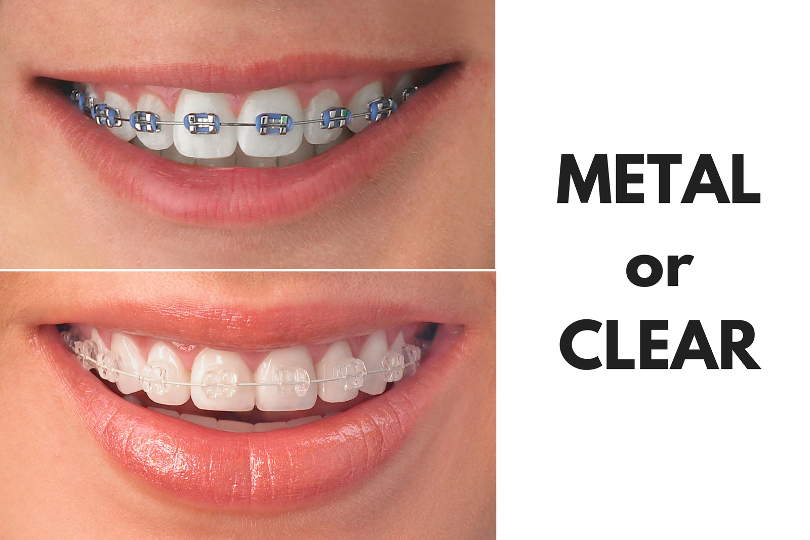 invisalgn clear or metal braces which one ideal orthdontic option in vasundhara, ghaziabad