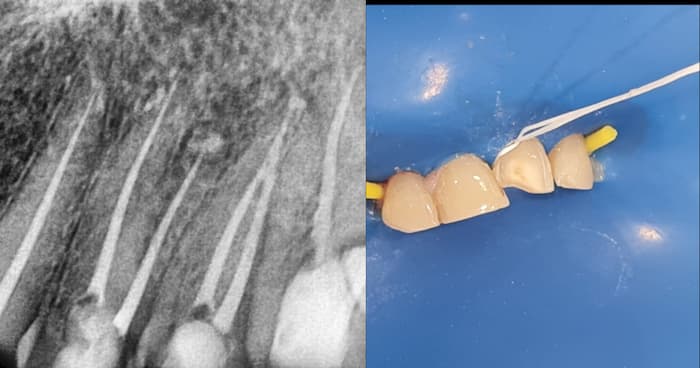 best dentist for root canal treatment in sector 76, noida