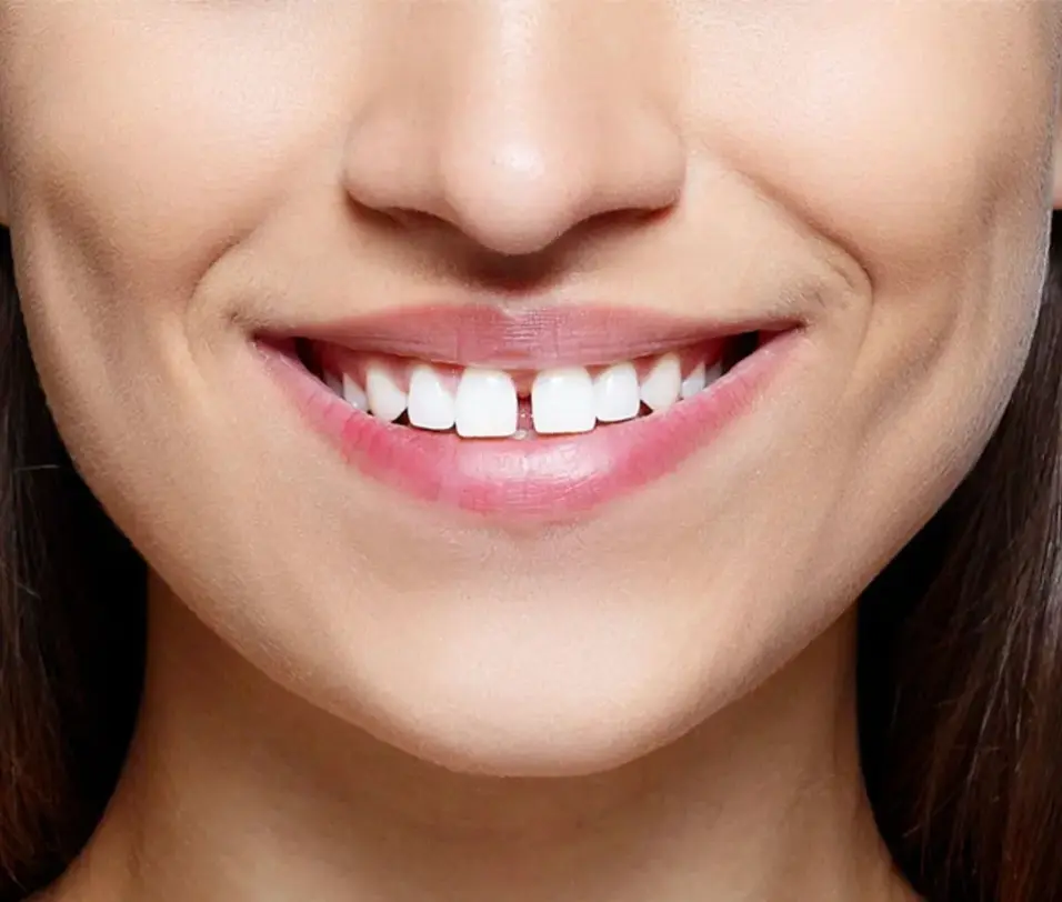 Cosmetic Dental Treatments in Dilshad Garden