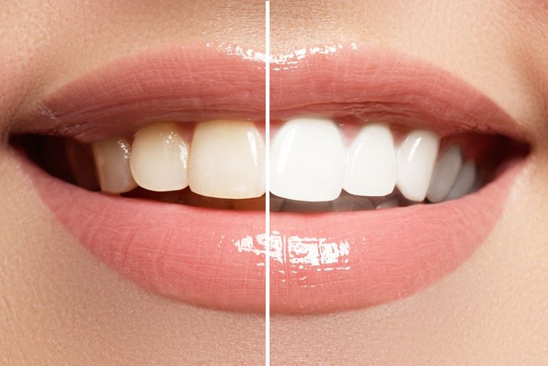 Best Teeth Whitening Discoloration Treatment in Ashok Vihar.