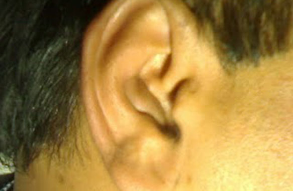 Psudocyst of auricle