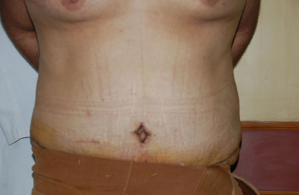 Abdomino Plasty Post Operative
