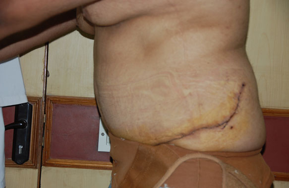 Abdomino Plasty Post Operative 2
