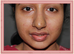 Rhinoplasty (nose) Post Operative