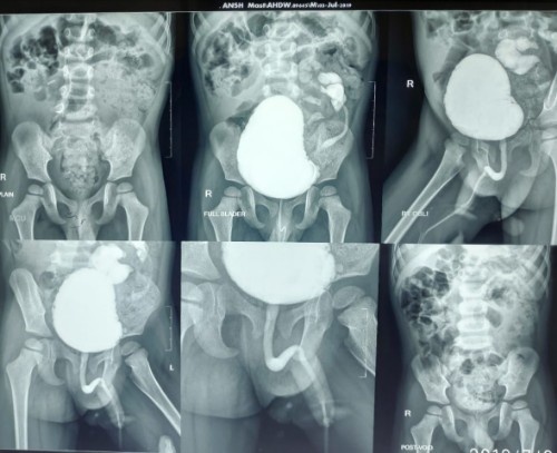 Diagnosis: Right crossed fused ectopia with neurogenic bladder with severe constipation