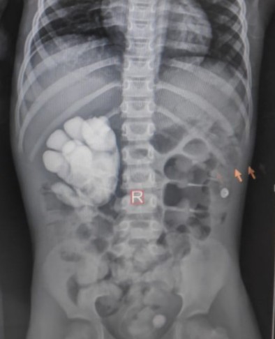 Right kidney Grade 5 Reflux with Dysplastic Kidney