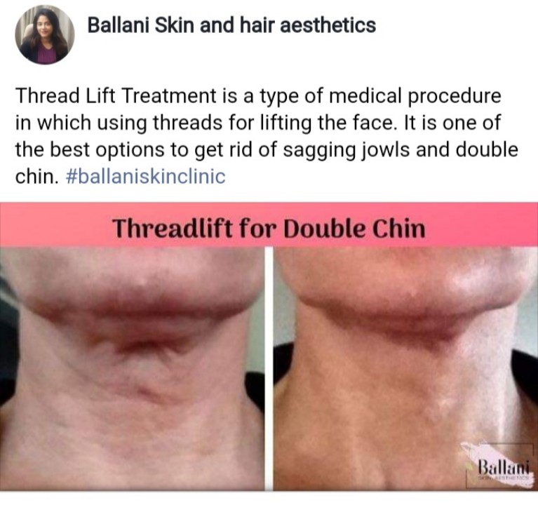 Thread Lift Treatment for Double Chin at Ballani Skin And Hair Aesthetics