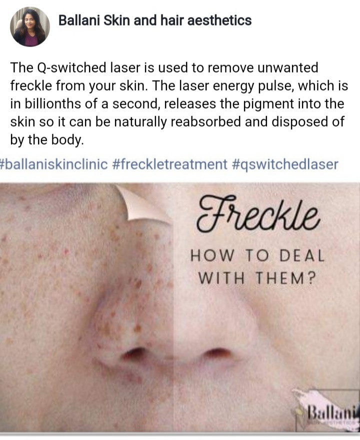 Freckle Treatment By Laser at Ballani Skin And Hair Aesthetics