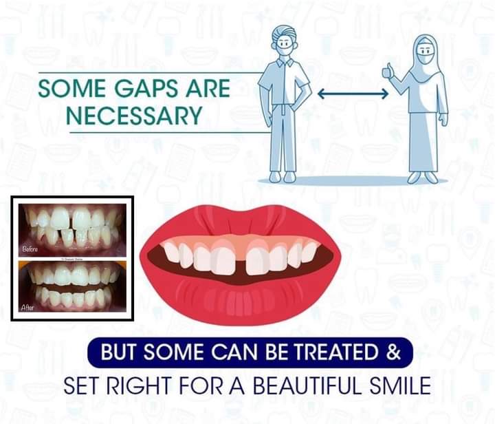 Dental Gaps Treatment in Raj Nagar, Ghaziabad