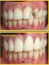 Crooked teeth treatment in ashok vihar