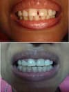 Teeth Gap Closure Treatment