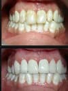 Teeth Whitening & Cleaning