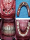 Dental implants (implantologist)