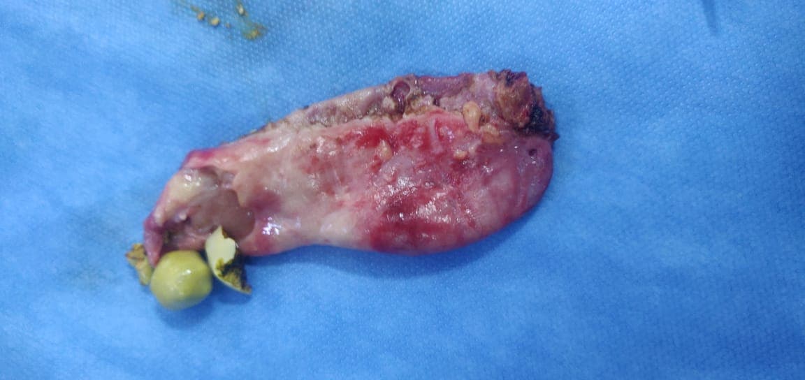 Gall Bladder Removal After Surgery