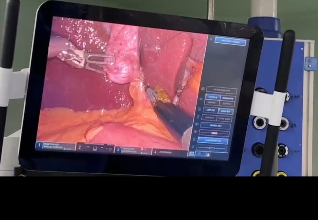 Robotic Cholecystectomy (gall bladder stone surgery) By - Da Vinci robot