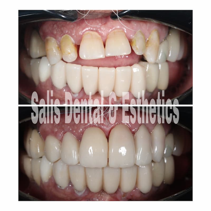 Bite correction with Zirconia Crowns Treatment in Sector 74, Noida