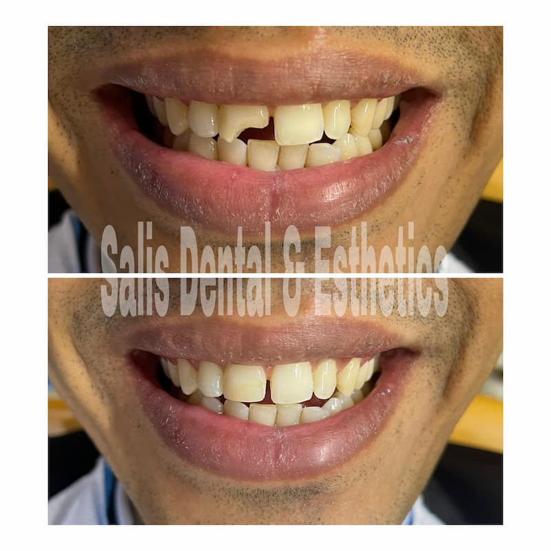 Aesthetic Composite Restoration in Sector 74, Noida