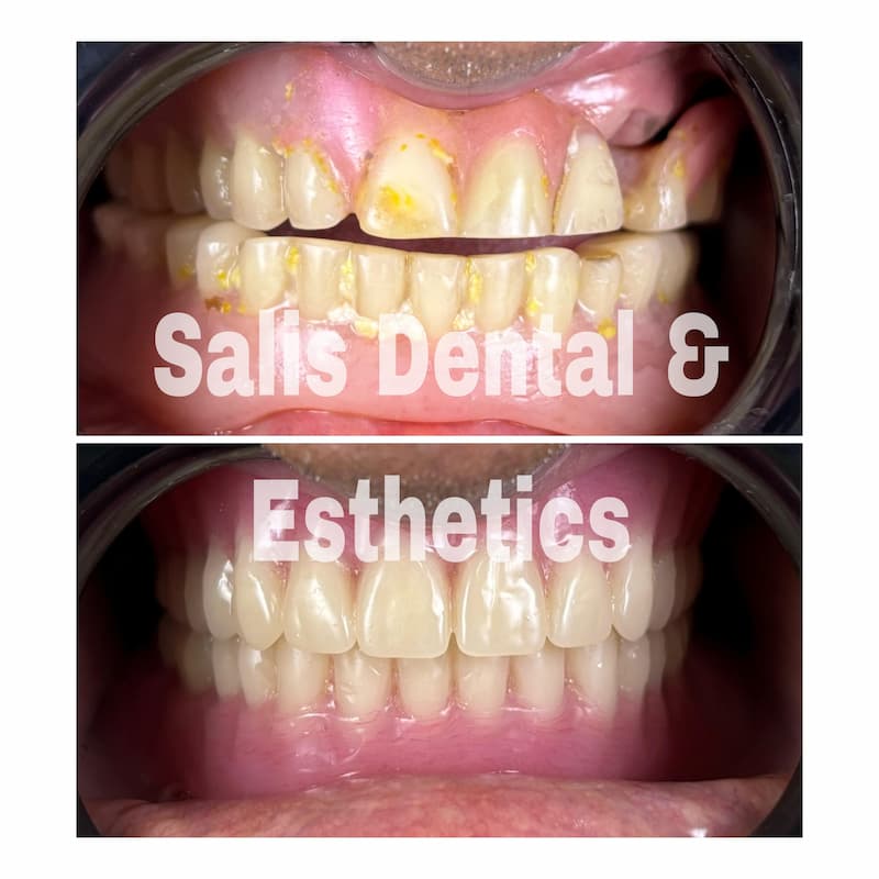 Complete Denture Treatment in Sector 74, Noida