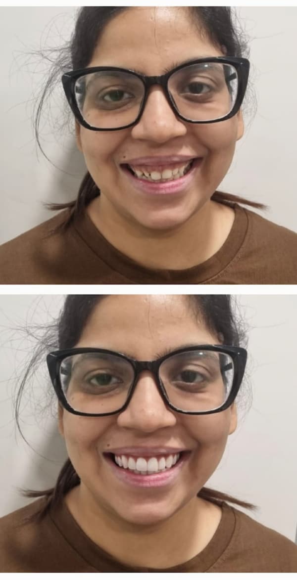 Best Before After Dental Results in Model Town Delhi